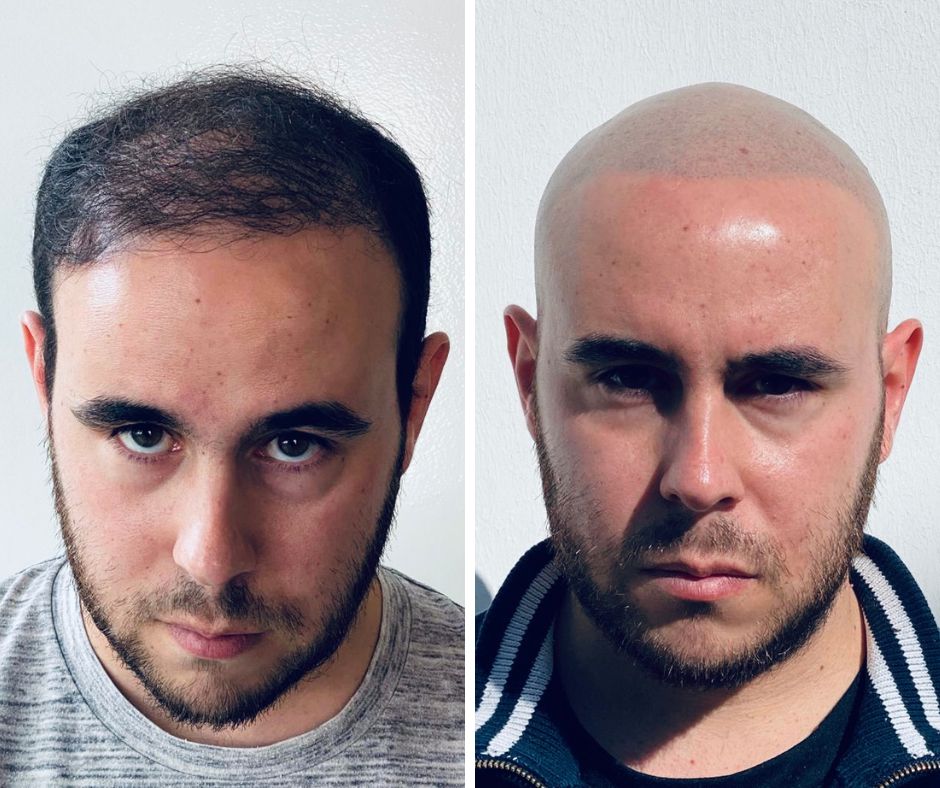 effet crane rase - résultat face - patient Andrew