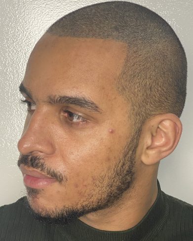 Alex après densification droit