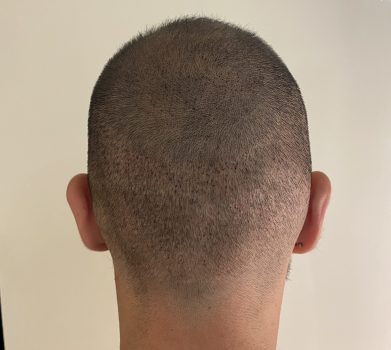 Après Densification capillaire homme