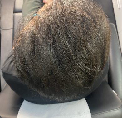 Densification Homme Après