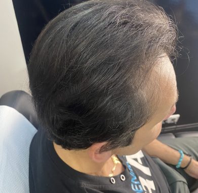Densification homme après droit