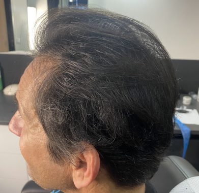 Densification homme après gauche