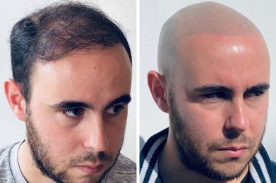 effet crane rase - résultat droit - patient Andrew