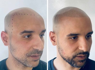 effet crane rase - résultat droit - patient Salim