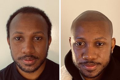 effet crane rase - résultat face - patient Alexandre