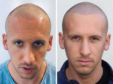 effet crane rase - résultat face - patient Julien