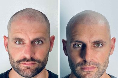 effet crane rase - résultat face - patient Maxime
