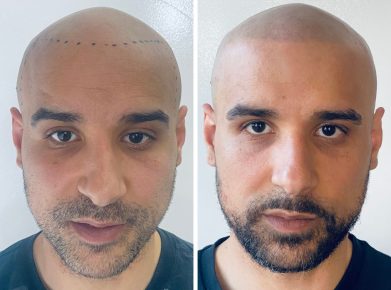 effet crane rase - résultat face - patient Salim