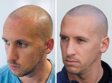 effet crane rase - résultat gauche - patient Julien