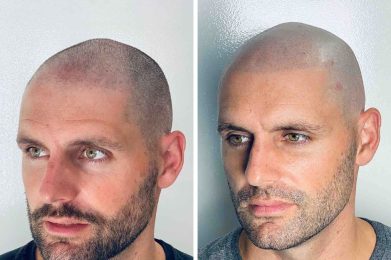 effet crane rase - résultat gauche - patient Maxime