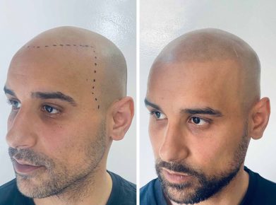 effet crane rase - résultat gauche - patient Salim